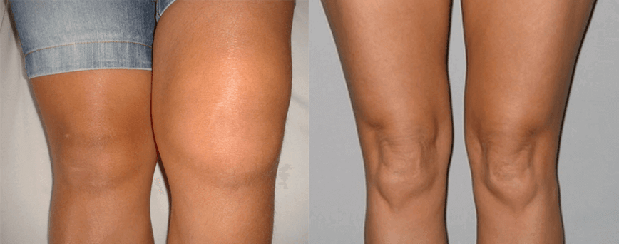 Experiență în utilizarea capsulelor de ulei de canabis înainte și după utilizare de la Eva